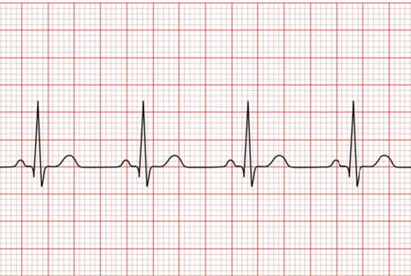 ECG